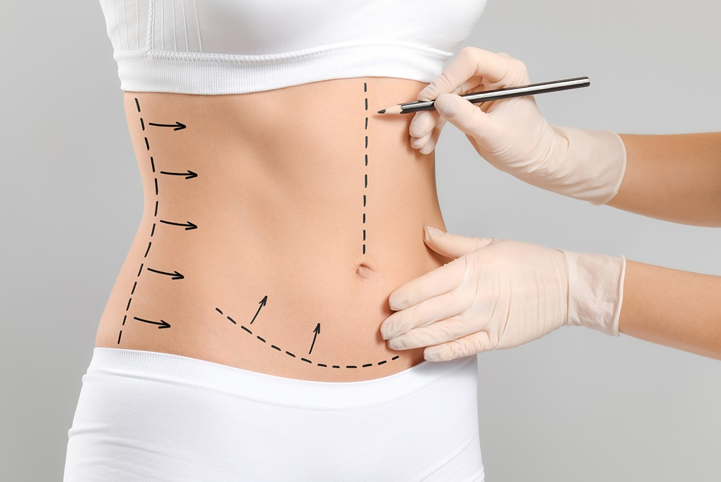 Tummy Tuck in Islamabad: Complete Guide to Abdominal Contouring